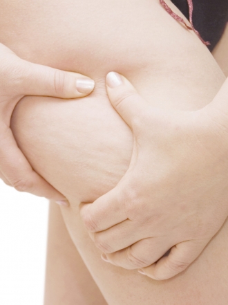 Cómo eliminar la celulitis: los métodos más efectivos