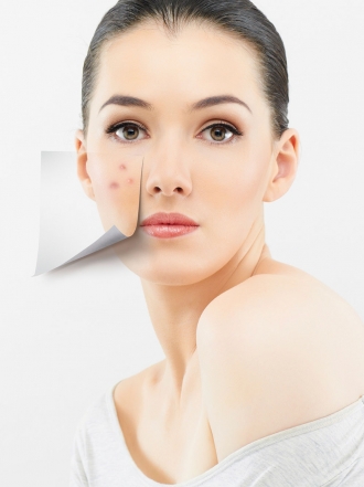 Cómo combatir el acné: causas, tipos y tratamientos para los granos