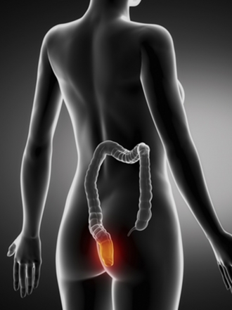 Las hemorroides externas: síntomas y tratamientos