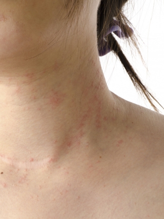 Remedios caseros para los síntomas de la dermatitis