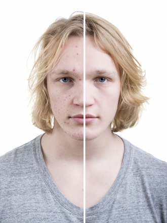 Acné severo: qué es y cómo tratar los granos graves