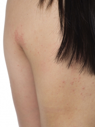 Remedios caseros para la psoriasis