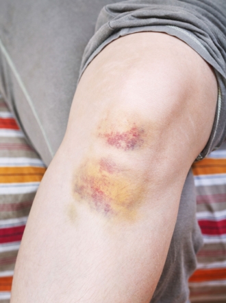 Remedios caseros para los moratones o cardenales