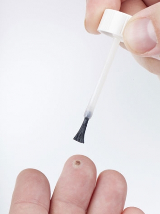 Remedios caseros para eliminar las verrugas