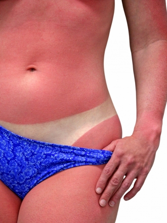 7 razones por las que proteger tu piel de las quemaduras del sol