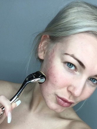 Di adiós a las marcas de acné con el rodillo facial