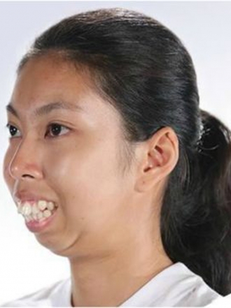 La conmovedora historia de superación de la chica sin barbilla