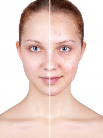 Qué es la rosácea y cómo debe tratarse