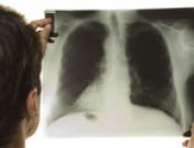 Tuberculosis: en qué consiste, síntomas y tratamiento