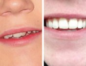 Niall Horan revoluciona Twitter con la foto de su nueva sonrisa