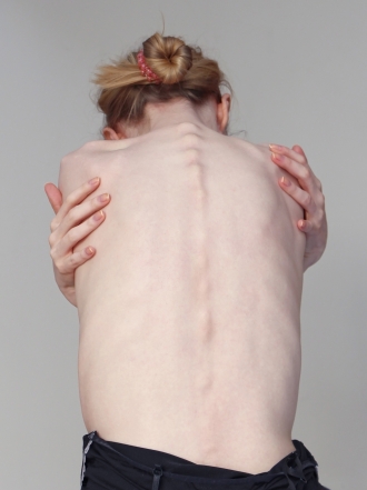 Señales para reconocer la anorexia y la bulimia