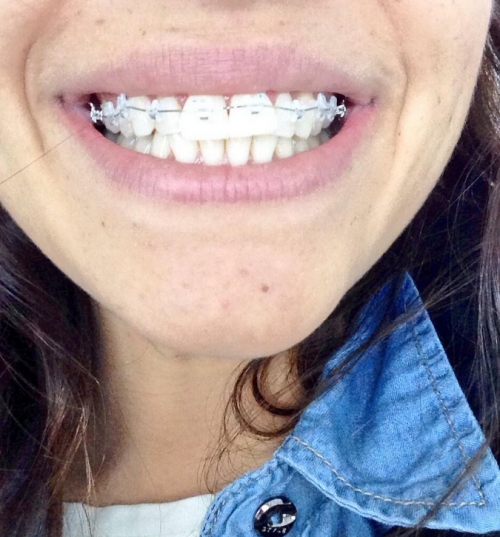 Sonia Walls se pone aparato: la sonrisa más bonita de GH