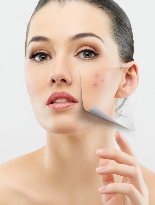 El acné no es sólo un problema en la piel de adolescentes