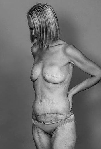 Beth Whaanga muestra las cicatrices del cáncer Beth Whaanga muestra las cicatrices del cáncer