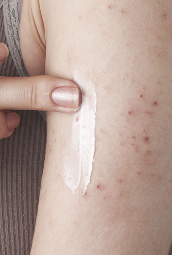 vía sitio Bolsa Remedios caseros para la alergia en la piel