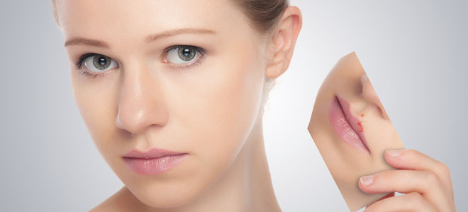 Herpes labial