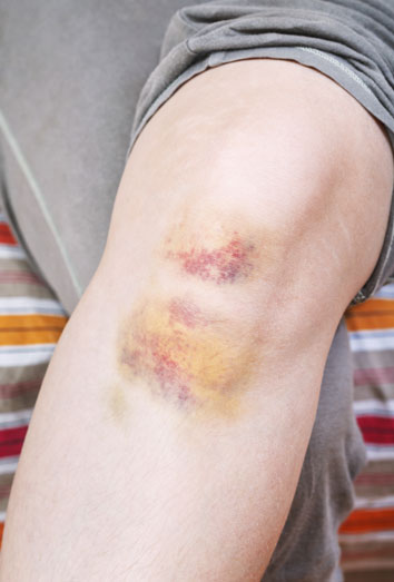 Remedios caseros para los moretones