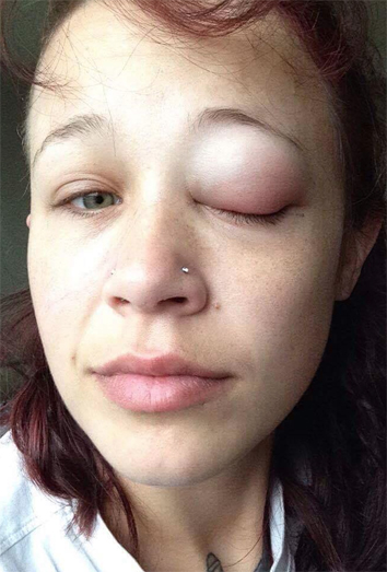 Cat Gallinger quiere concienciar sobre los peligros de los tatuajes en los ojos Cat Gallinger quiere concienciar sobre los peligros de los tatuajes en los ojos