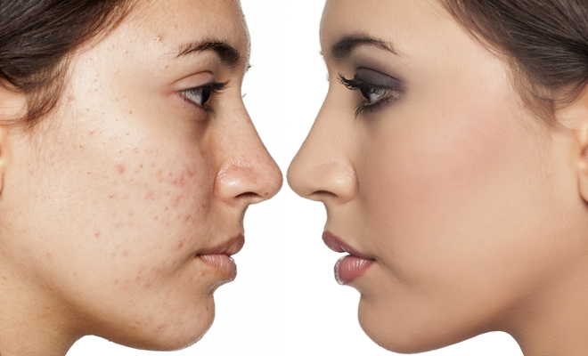 Tienes acné? 15 tips de maquillaje para disimular granitos