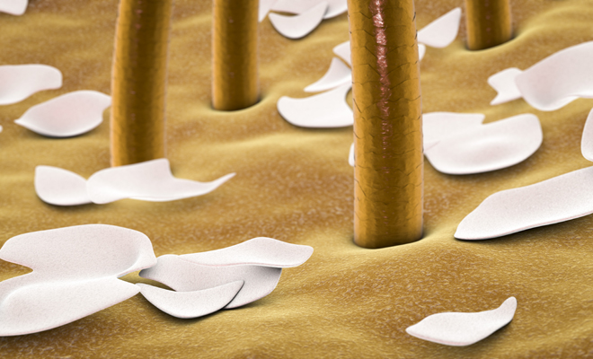 Tips para que no vuelva la caspa