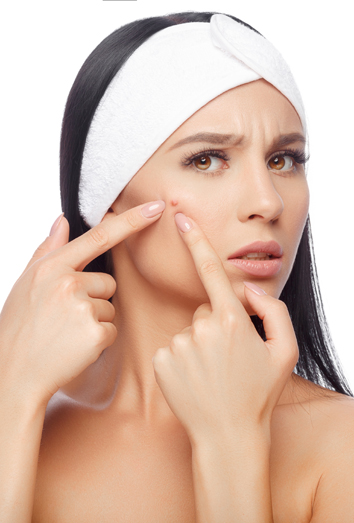 Consejos para prevenir el acné Consejos para prevenir el acné