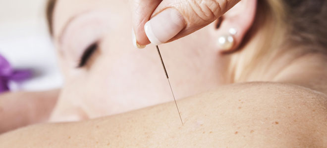 Acupuntura para adelgazar
