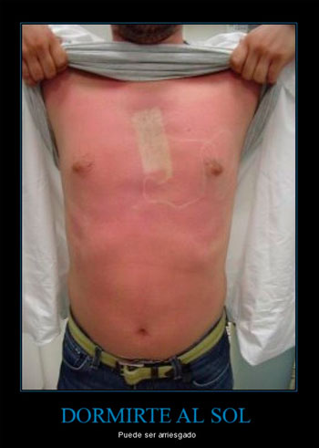 Burradas en la piel.  Burradas en la piel.