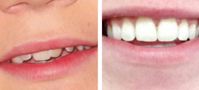 el antes y despues de la sonrisa de niall horan el antes y despues de la sonrisa de niall horan