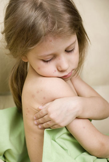 Remedios caseros para la varicela