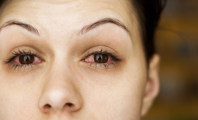 Los síntomas más comunes de la conjuntivitis alérgica Los síntomas más comunes de la conjuntivitis alérgica