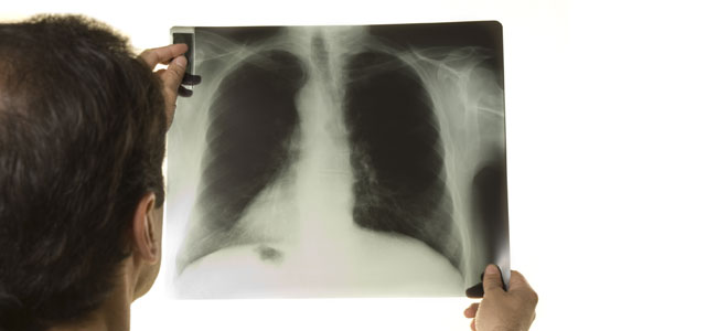 tuberculosis Tuberculosis